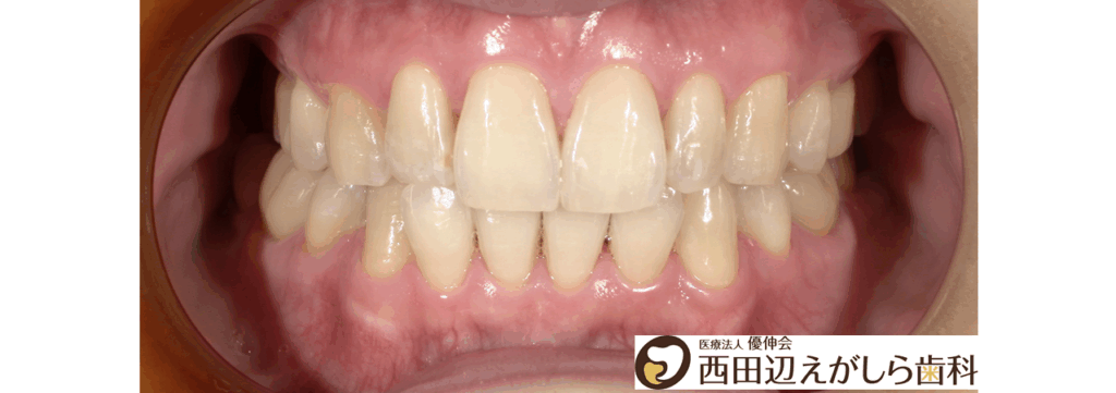 ホワイトニング　歯　術後　西田辺えがしら歯科