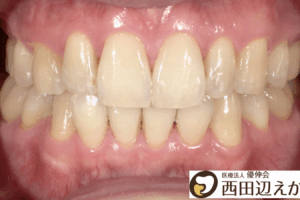 ホワイトニング　歯　術後　西田辺えがしら歯科