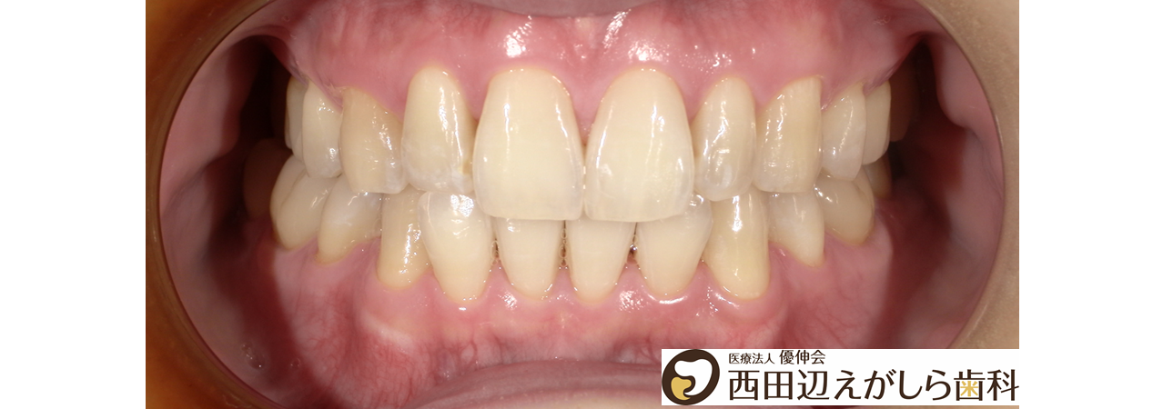 東住吉区在住　ホワイトニング症例　30才代　女性