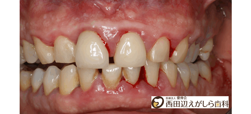 歯周病 大腸がん 関係 細菌 西田辺えがしら歯科 歯医者