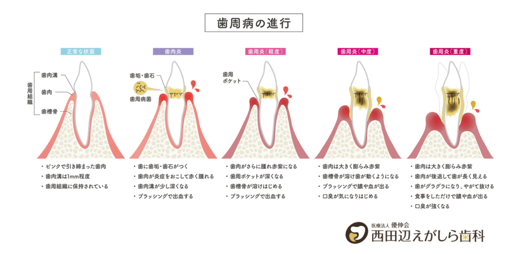 歯周病 大腸がん 関係 細菌 西田辺えがしら歯科 歯医者