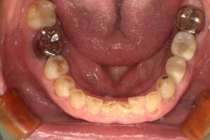 インプラント治療　術後　西田辺えがしら歯科