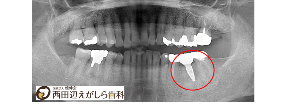 インプラント治療　症例　　西田辺えがしら歯科　　