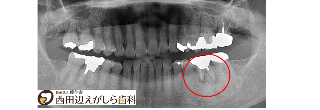 インプラント治療　症例　西田辺えがしら歯科　　