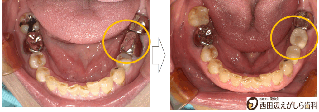 インプラント治療　術前　術後