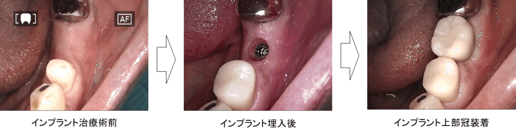 インプラント治療　術前　術中　術後　西田辺えがしら歯科
