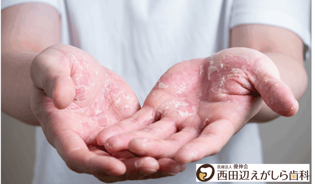 金属アレルギー　掌蹠膿疱症　西田辺えがしら歯科　阿倍野区