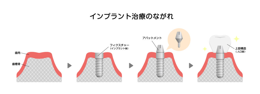 ソケットプリザベーション インプラント治療 骨再生材料 リフィット 歯医者 抜歯後