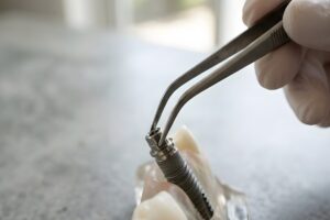 ソケットプリザベーション インプラント治療 骨再生材料　リフィット　歯医者　抜歯後